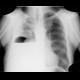 Pneumothorax, fluidopneumothorax, pleural drainage: X-ray - Plain radiograph